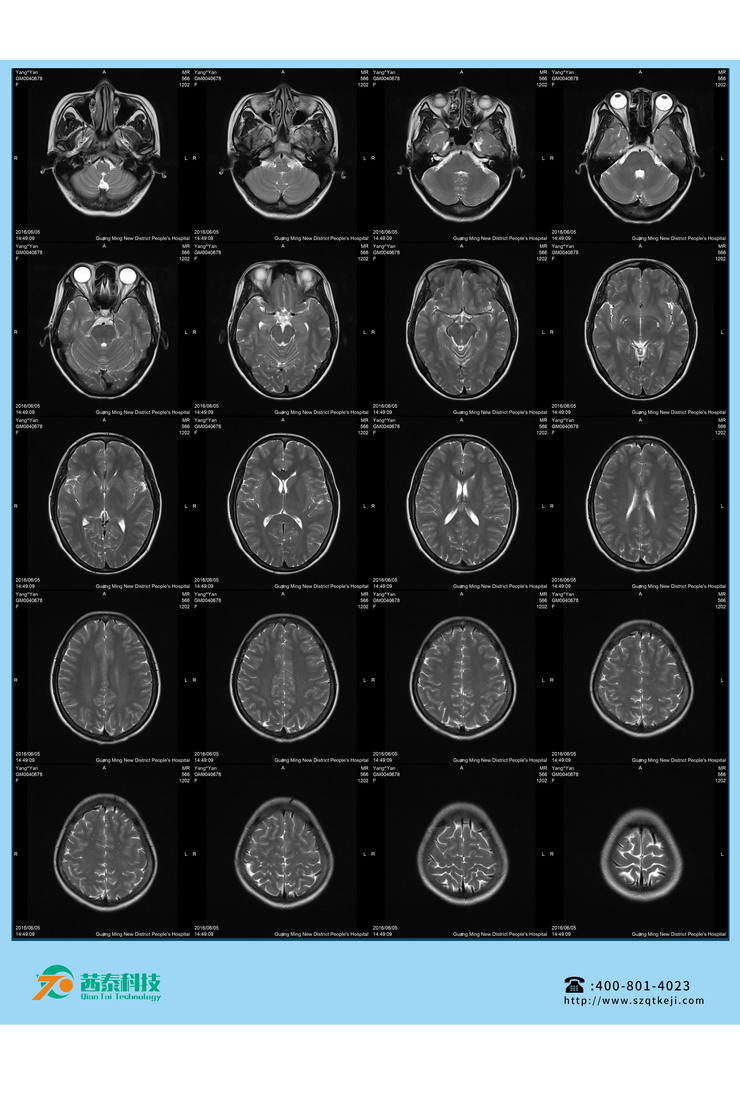 熱敏膠片-MR頭顱 (2).jpg